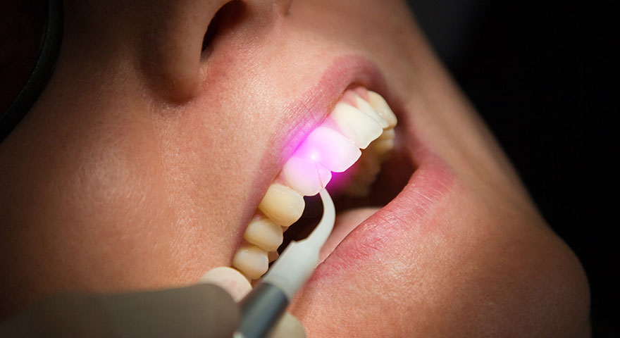 レーザーによる歯周ポケットの治療