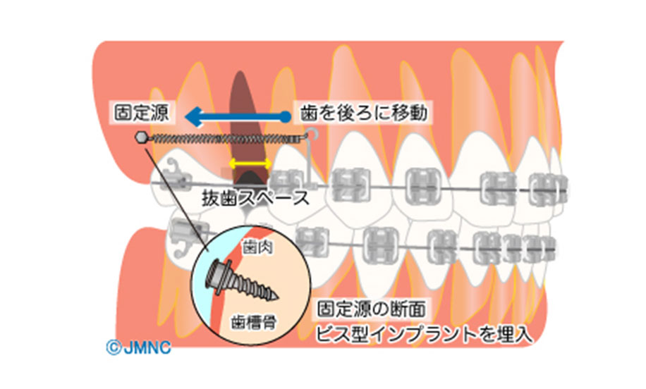 歯科矯正用アンカースクリューを利用した治療